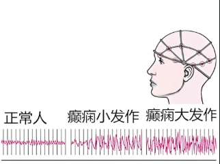 小儿癫痫的发作类型