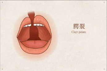 儿童唇腭裂